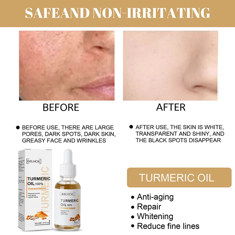 "Radiant Renewal: Advanced Acne Brightening Serum